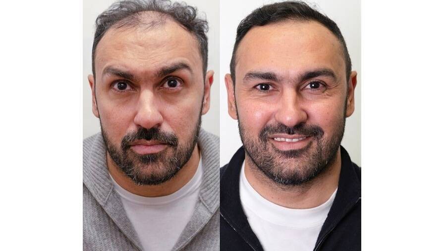 Футболист Ахмад эль-Мохаммади доволен результатом операции по пересадке волос