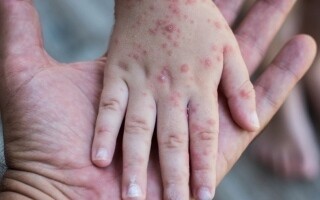 WHO: Global measles cases down 71%