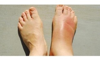 Understanding Edema and Food Intolerance