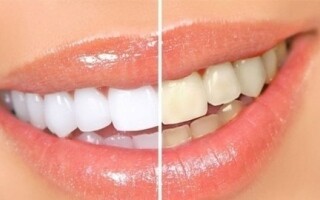 5 Natural Mixtures for Whitening Teeth