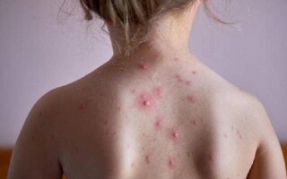 Объявлена глобальная чрезвычайная ситуация по оспе обезьян