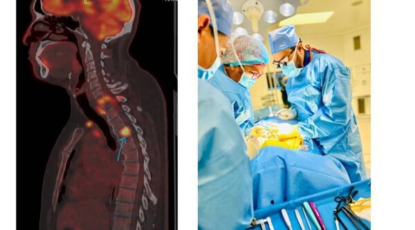 Complex Spine Surgery Performed in Dubai